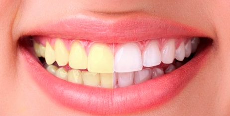 how to whiten teeth at home fast